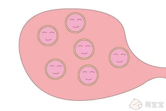 多囊卵巢综合征何时需要辅助生殖技术？